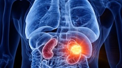 أعراض لمرض سرطان الكلى لا تظهر مبكرًا