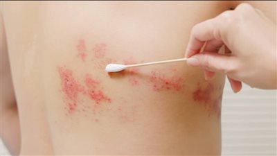 الفئات الأكثر عُرضة للإصابة بالحزام الناري وأعراضه