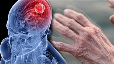 رؤية الكوابيس علامة مبكرة لمرض باركنسون