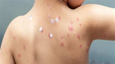 الجدري المائي.. الأعراض وطرق العلاج