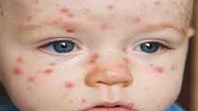 تأجيل الامتحانات وانتشاره في المدارس.. تفاصيل جديدة عن الجدري المائي 