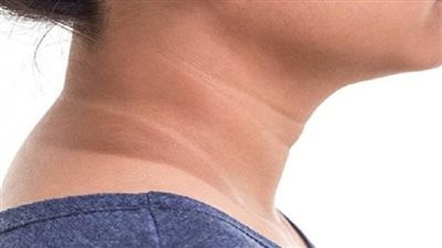 أعراض مقاومة الأنسولين وطرق علاجها