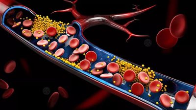 ارتفاع الكوليسترول يسبب أضرارًا خطيرة