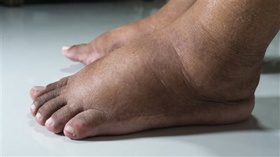 علامات تحذيرية في الساقين تدل على إصابتك بالسكري
