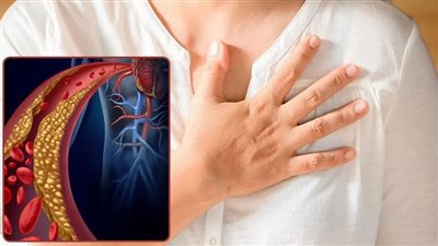 تشنجات في خمس مناطق علامة على ارتفاع الكوليسترول 