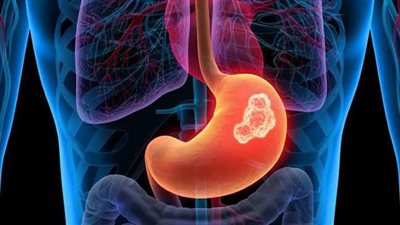 أبرزها فقدان الوزن.. أعراض سرطان المعدة