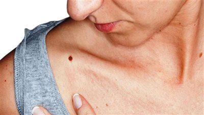 حبوب تحت الجلد.. أسباب الظهور وأسرع طرق العلاج