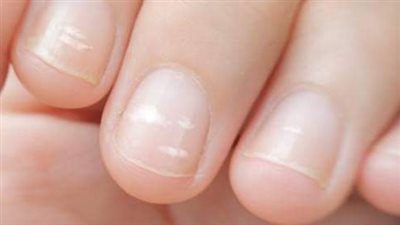 علامة غير معروفة لسرطان عدواني تظهر في الأظافر