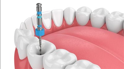 السعودية تبدأ توطين مهن طب الأسنان .. التفاصيل