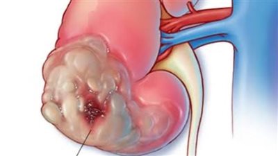 العلامات الأولى للإصابة بسرطان الكلى