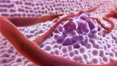 خدمة علاجية منزلية لمرضى سرطان البروستاتا والثدي القطريين