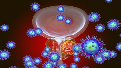 دراسة: تضاعف حالات سرطان البروستات حول العالم بحلول 2040