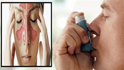 هل التهاب الجيوب الأنفية يسبب تدهور صحة مرضى الربو؟.. أطباء يوضحون