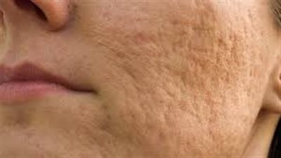 خطأ طبيب تجميل يتسبب في تشويه وجه مواطن.. تفاصيل