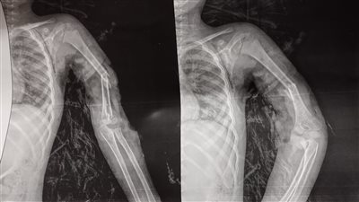 إنقاذ ذراع طفل من بتر كامل بمستشفى سوهاج الجامعي 
