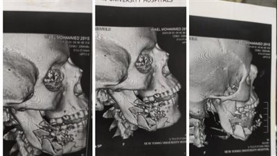 إجراء عملية جراحية ناجحة لمصاب بطلق ناري بعظام الرقبة بمستشفي سوهاج الجامعي