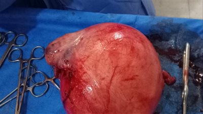 الفريق الطبي بمستشفى ادكو ينجح فى استئصال ورم وزنه 8 كجم