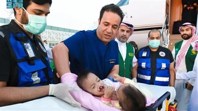 عملية لفصل التوأم السيامي الفلبيني 