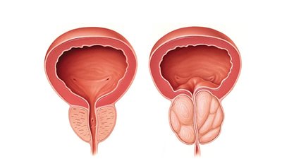 طبيب يكشف الأعراض الأولى لسرطان البروستاتا