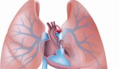 أعراض فرط ضغط الدم الرئوي