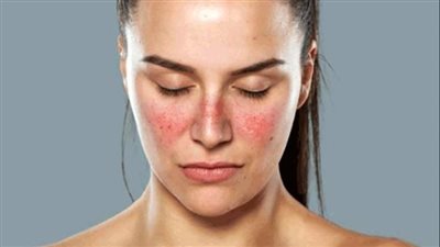 الجنس أولها.. ٣ أسباب صادمة تزيد من خطر الإصابة بمرض الذئبة (احذر)