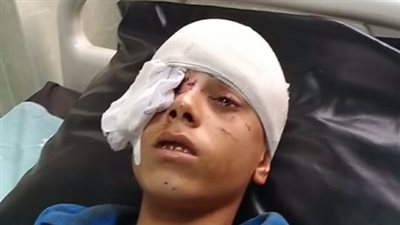 إصابة طالبين بمدرسة مبارك كول بعاهة مستديمة خلال التدريب بإحدى الشركات