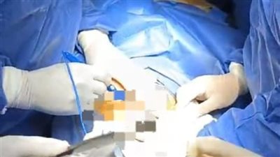 صحة الشرقية: إجراء عملية نوعية عالية المهارة للمرة الأولى بقسم النساء بمستشفى أبوحماد