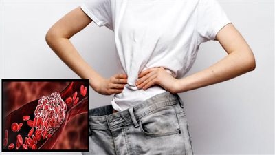  فقدان الوزن المفاجئ يؤدي إلى تطور تجلط الدم