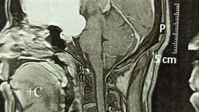 إستئصال ورم لشاب عشريني بسوهاج الجامعي ينقذه من فقدان البصر