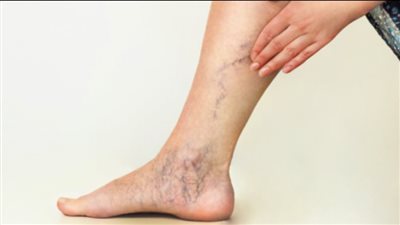  لماذا تنتفخ الأوردة في الجبهة واليدين؟