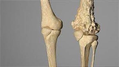 علماء يطورون تقنيات حديثة للكشف عن سرطان العظام