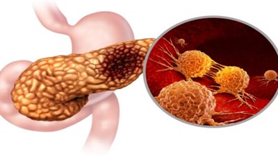 طبيب يوضح صعوبة تشخيص سرطان البنكرياس