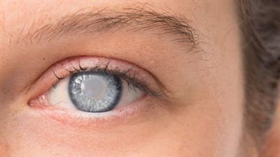 طبيب يكشف أسباب اعتام عدسة العين في سن مبكر