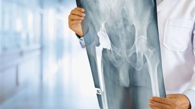 علاج واعد يستهدف سرطان العظام.. تفاصيل 