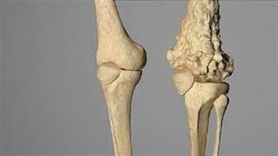 علاج جديد يستهدف أخطر أنواع سرطان العظام