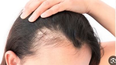 طرق طبيعية لتحفيز نمو بصيلات الشعر 