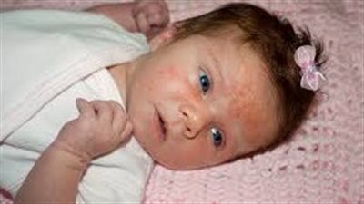 أسباب حدوث الإكزيما عند الأطفال