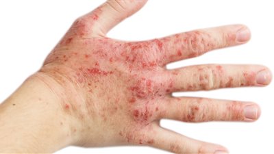 الأطعمة المالحة تحفز الإصابة بالأكزيما