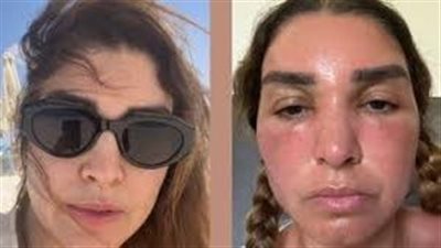 الجمهور يبحث عن روجينا بعد ظهورها بوجه منتفخ ومتورم (صور) 