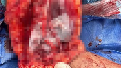 مستشفي سوهاج تنقذ ذراع طفل مصاب بقطع كامل بالشرايين والأعصاب بإعادة توصيلها