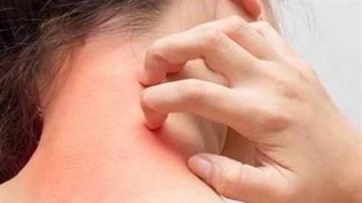 فصل الصيف يزيد من خطر الإصابة بأنواع مختلفة من الحساسية