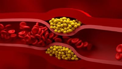 مكون سحري يقضي على تصلب الشرايين