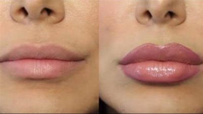حضري ماسك طبيعي لتكبير الشفاه وتمتعي ببديل صحي للفيلر
