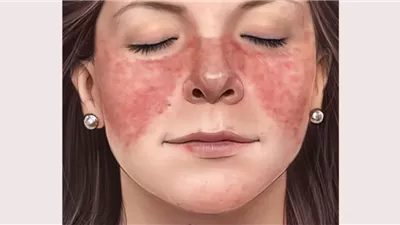 طبيبة تكشف عن أسباب ظهور الطفح الجلدي على الوجه