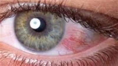 أسباب ارتفاع ضغط العين.. تعرف عليها 