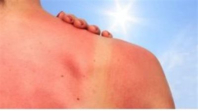 أضرار أشعة الشمس فوق البنفسجية