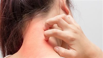 ماهي اعراض الحزام الناري وطرق علاجه