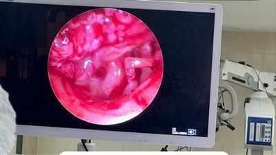 فريق طبي بجامعة سوهاج ينجح في توصيل عظيمات الأذن الوسطي لمريض