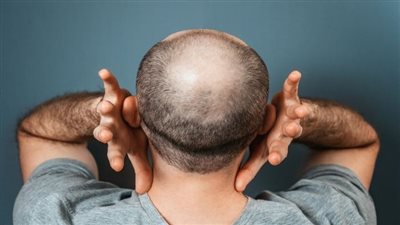 طفرة في علاج الصلع.. سكر طبيعي يحفز إعادة نمو الشعر بشكل كبير