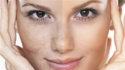 تصبغ الوجه يشير إلى مرض الكبد.. طبيبة أمراض جلدية تكشف التفاصيل 